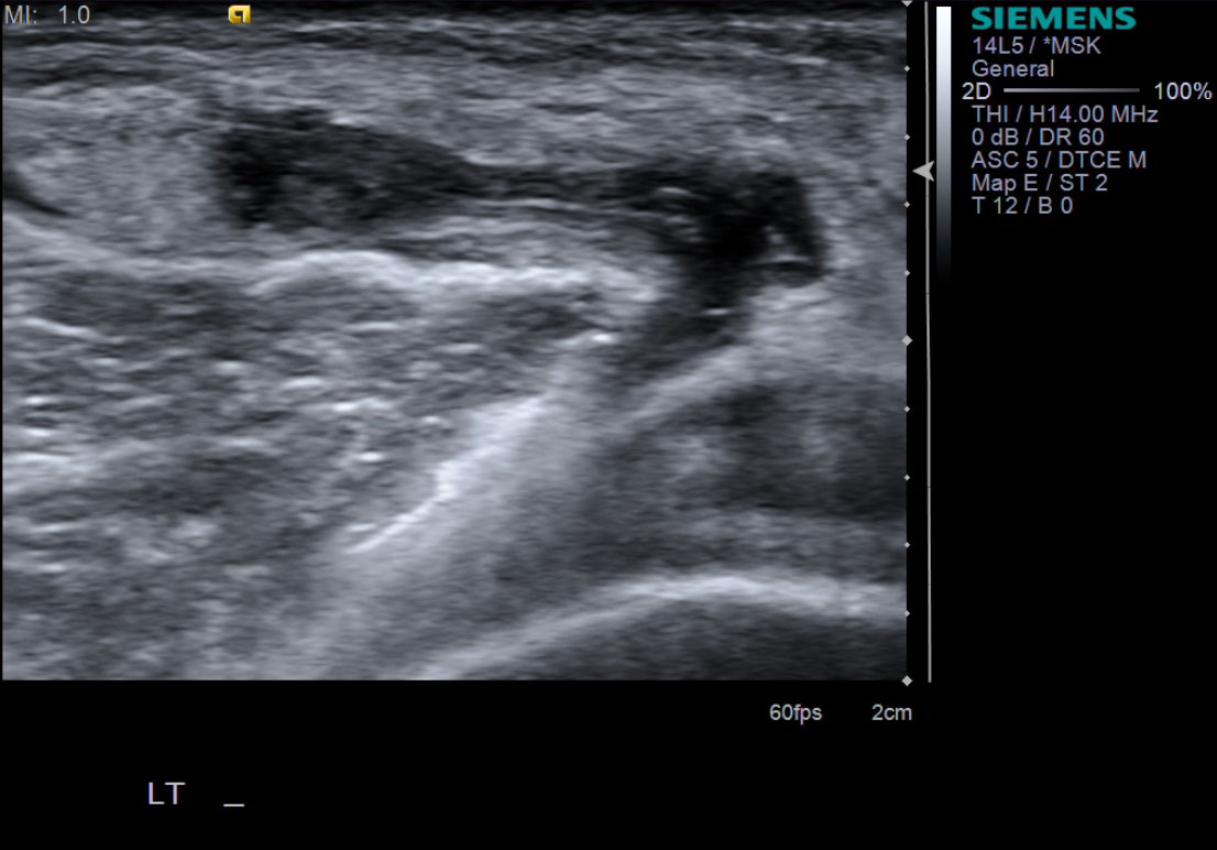 Needle in cyst