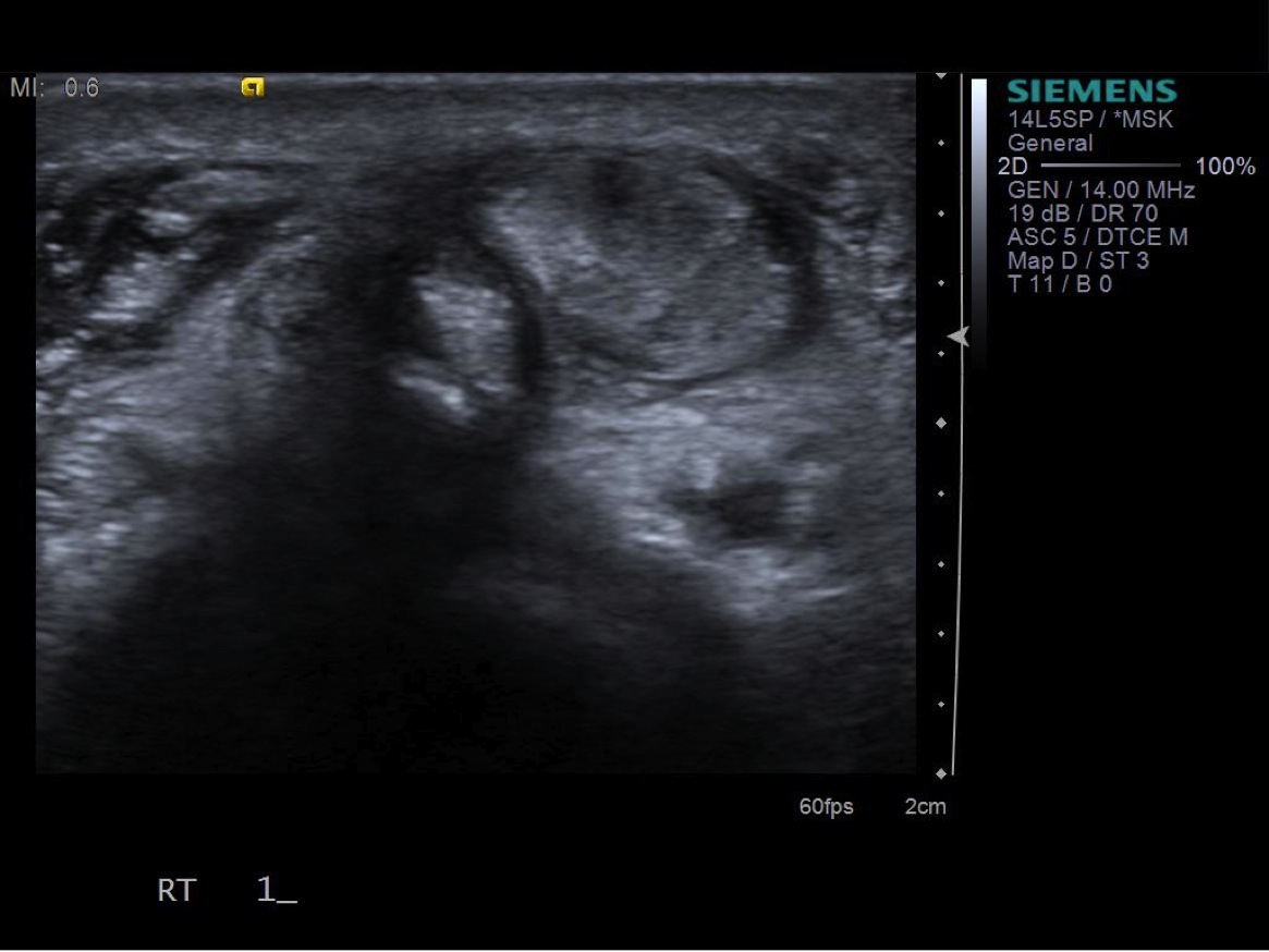 de Quervain's Injection — MSK Ultrasound Procedures